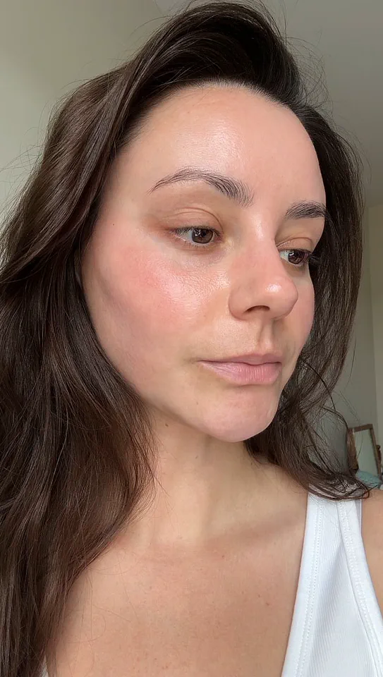 Beauty Industry in Crisis: The Alarming Rise of 'Beauty Editor’s Curse' and Perioral Dermatitis