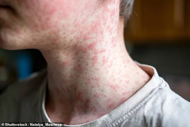 Measles Outbreak Resurgence: US at Risk of Losing Elimination Status