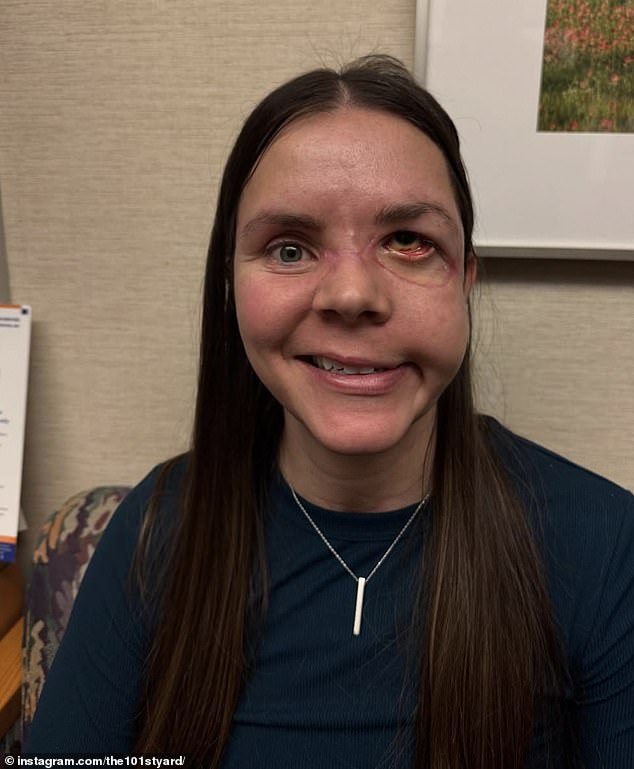 Kenai mother reveals full extent of bear attack injuries eight months later